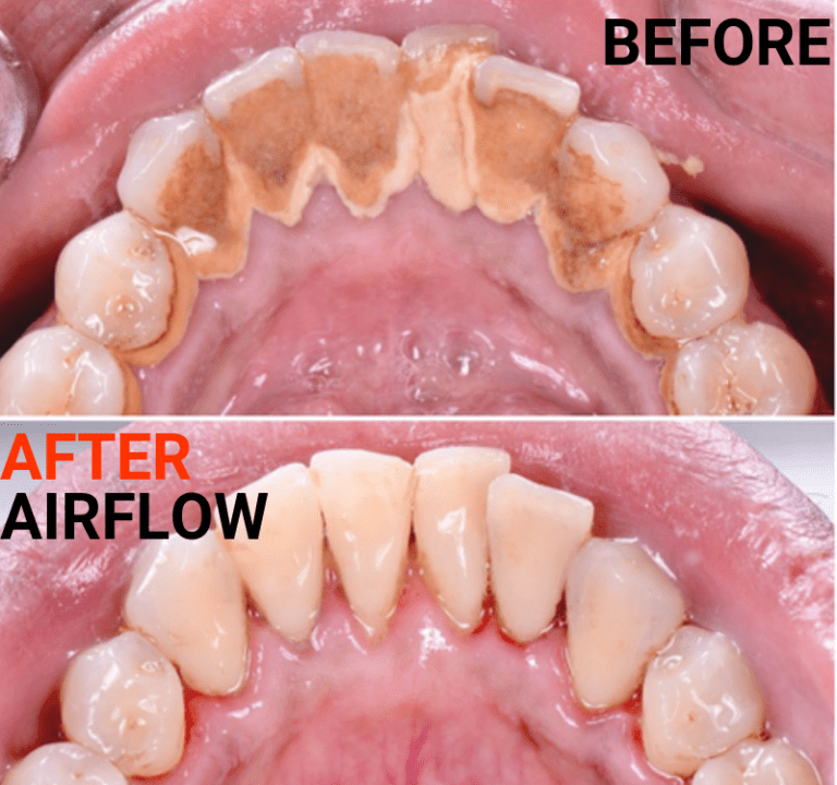 Why Use Airflow Ems For Teeth Cleaning Heritage Dental Group