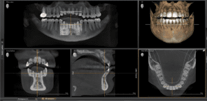 3D Cone Beam Scan at your dentist