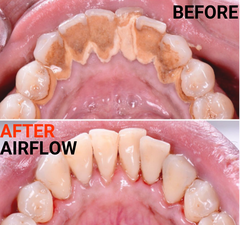 Why use Airflow EMS for Teeth cleaning? - Heritage Dental Group