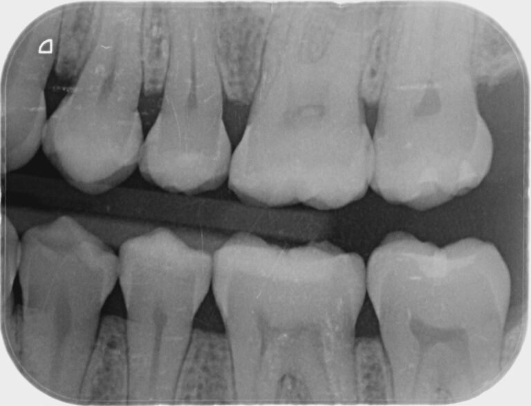 Why my Dentist need X-rays? - Heritage Dental Group