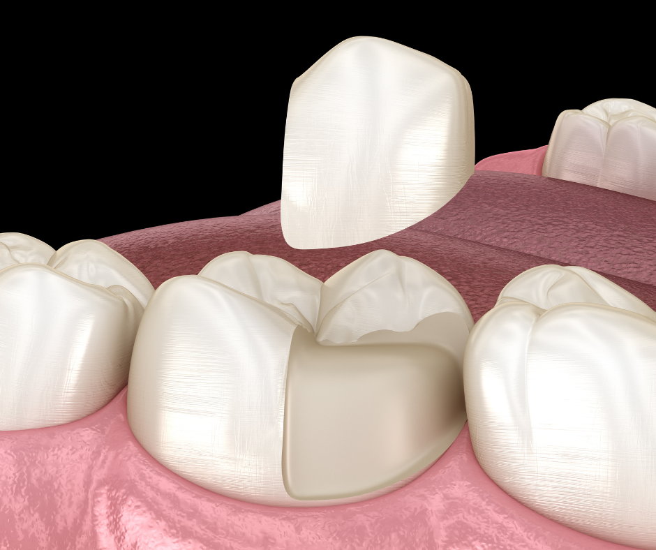 Dental Inlays And Onlays - Heritage Dental Group