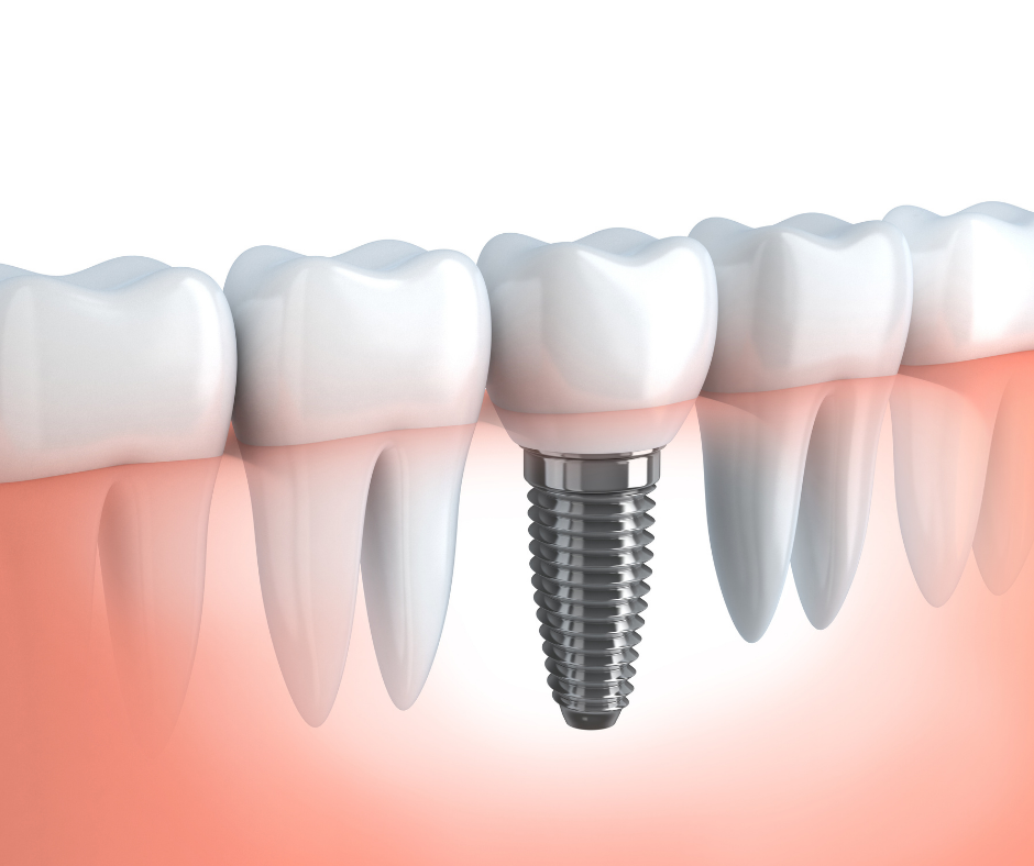 Dental Implants Indooroopilly I Heritage Dental Group