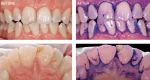 Disclosing teeth to clean with Airflow