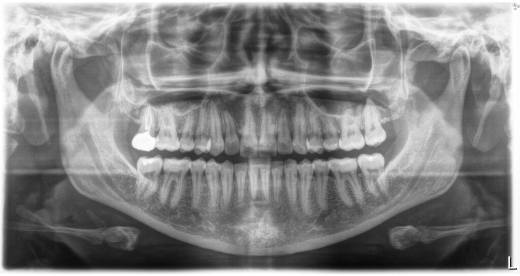 Why my Dentist need X-rays? - Heritage Dental Group