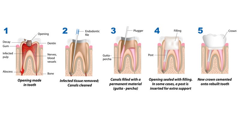 Root canal procedure - Heritage Dental Group