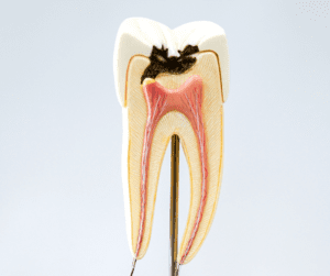 3 tips to prevent dental decay